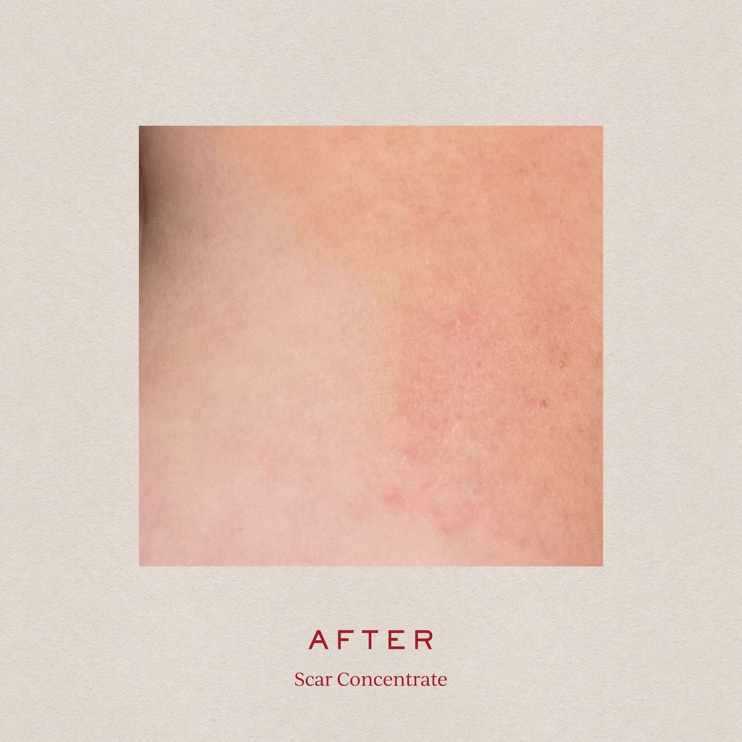 SCAR CONCENTRATE