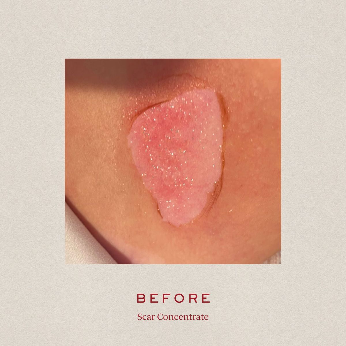 SCAR CONCENTRATE